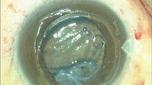 深板层角膜移植联合自体角膜层间垫片术治疗角膜穿孔